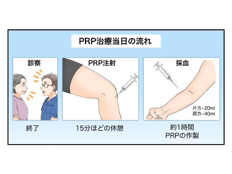 ＰＲＰ治療当日の流れまずは、採血をします。片足の場合は２０ｍｌ、両足の場合は４０ｍｌ程度採取します。その後、約１時間かけてＰＲＰを作製します。ＰＲＰ注射を行ったら、１５分ほどの休憩をしていただきます。最後に医師との診察を行い、終了となります。